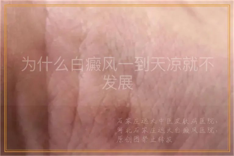 为什么白癜风一到天凉就不发展