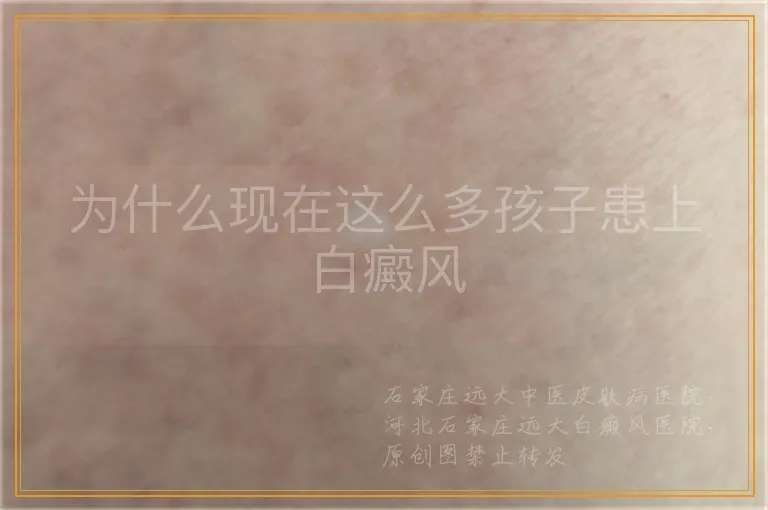为什么现在这么多孩子患上白癜风