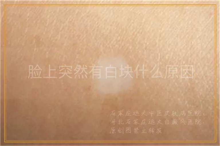 脸上突然有白块什么原因