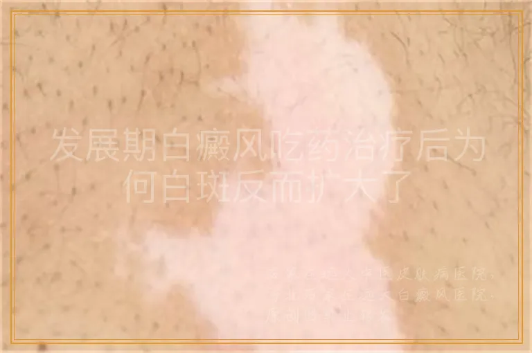 发展期白癜风吃药治疗后为何白斑反而扩大了