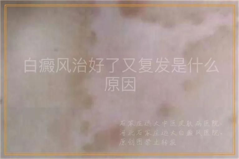 白癜风治好了又复发是什么原因