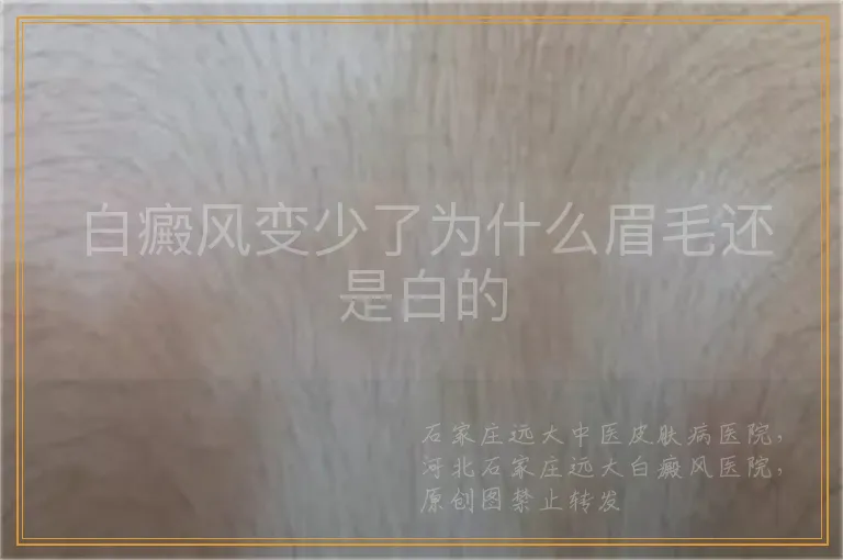 白癜风变少了为什么眉毛还是白的