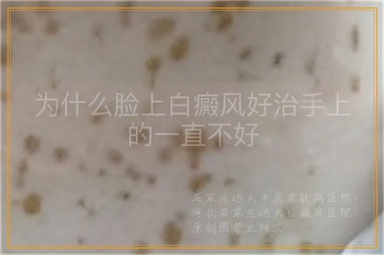 为什么脸上白癜风好治手上的一直不好