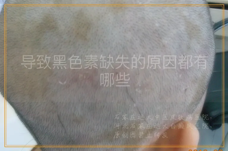 导致黑色素缺失的原因都有哪些