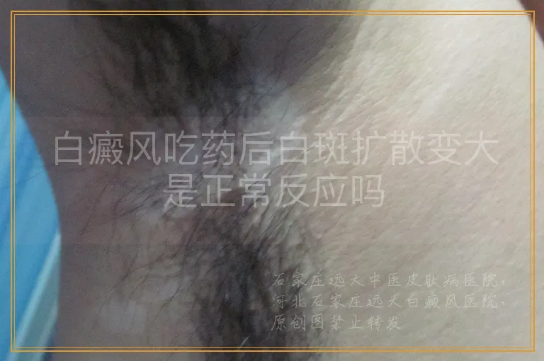 白癜风吃药后白斑扩散变大是正常反应吗