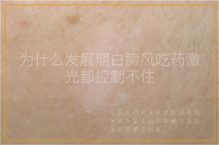 为什么发展期白癜风吃药激光都控制不住