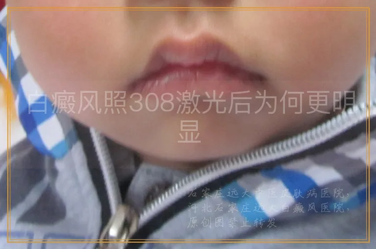 白癜风照308激光后为何更明显