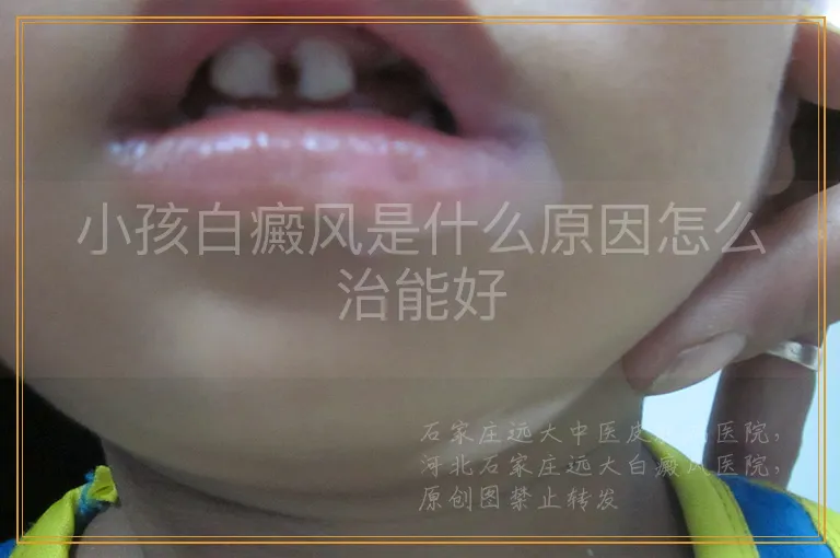 小孩白癜风是什么原因怎么治能好
