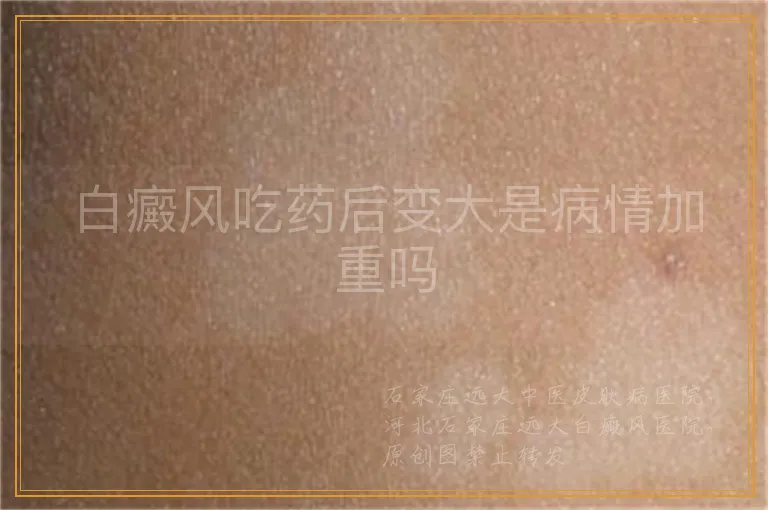 白癜风吃药后变大是病情加重吗