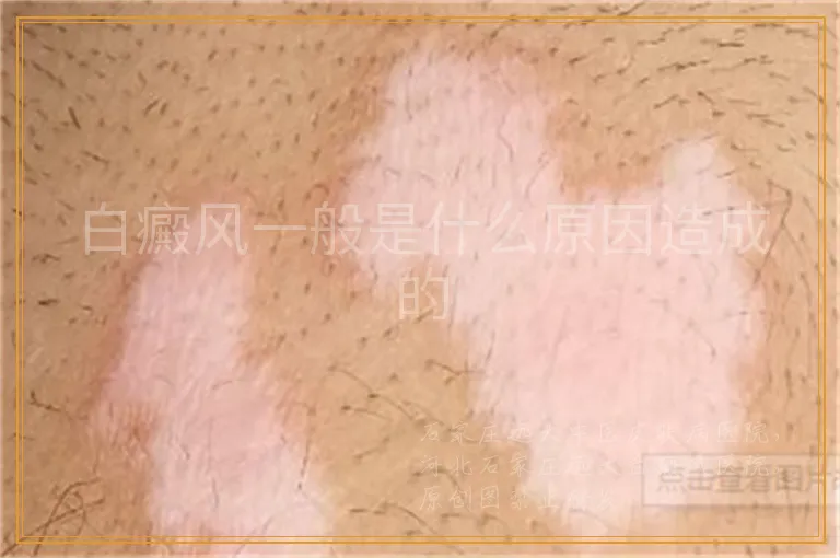 白癜风一般是什么原因造成的