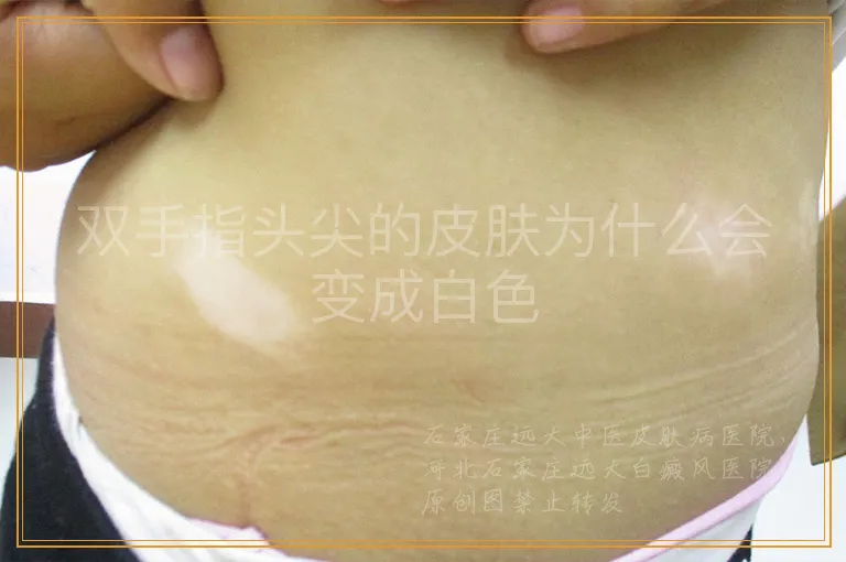 双手指头尖的皮肤为什么会变成白色