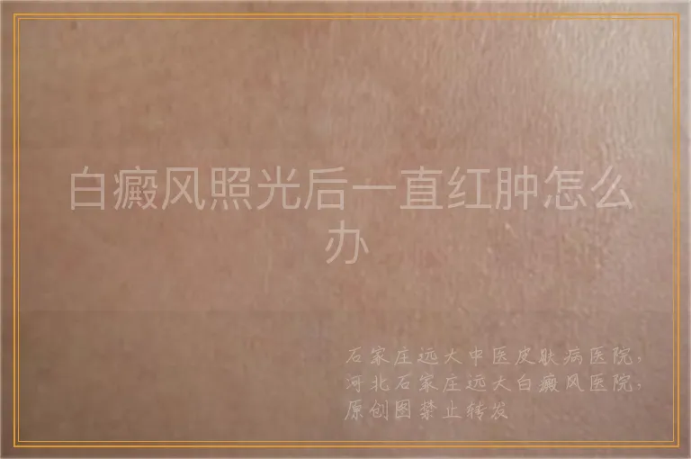 白癜风照光后一直红肿怎么办
