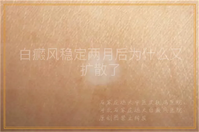 白癜风稳定两月后为什么又扩散了