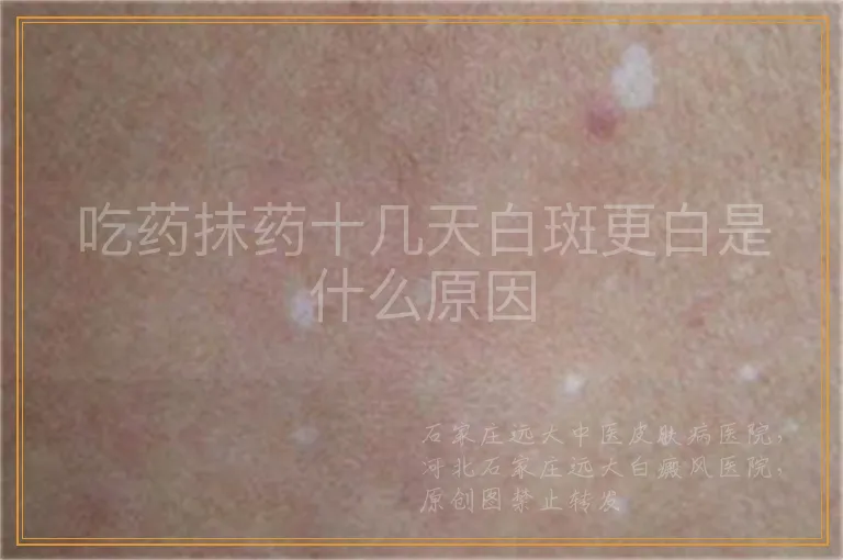 吃药抹药十几天白斑更白是什么原因