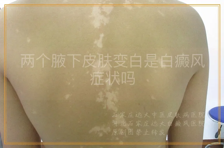 两个腋下皮肤变白是白癜风症状吗
