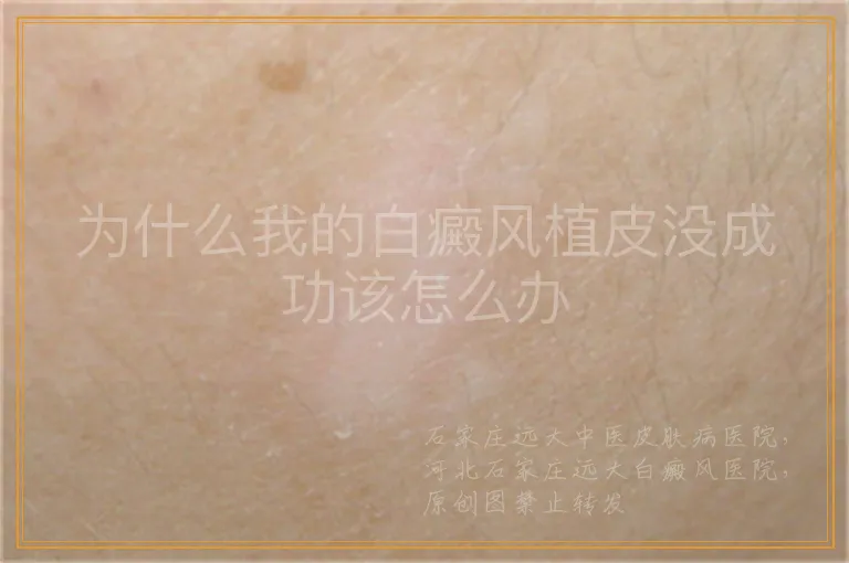 为什么我的白癜风植皮没成功该怎么办