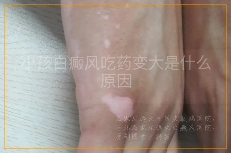 小孩白癜风吃药变大是什么原因