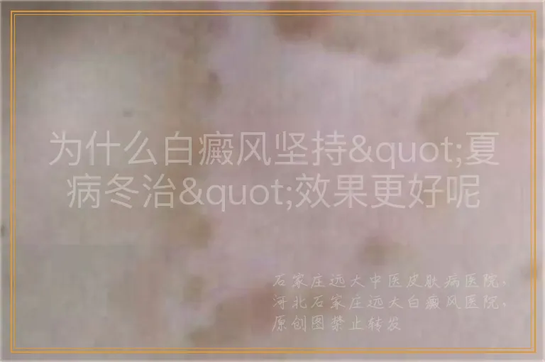 为什么白癜风坚持"夏病冬治"效果更好呢