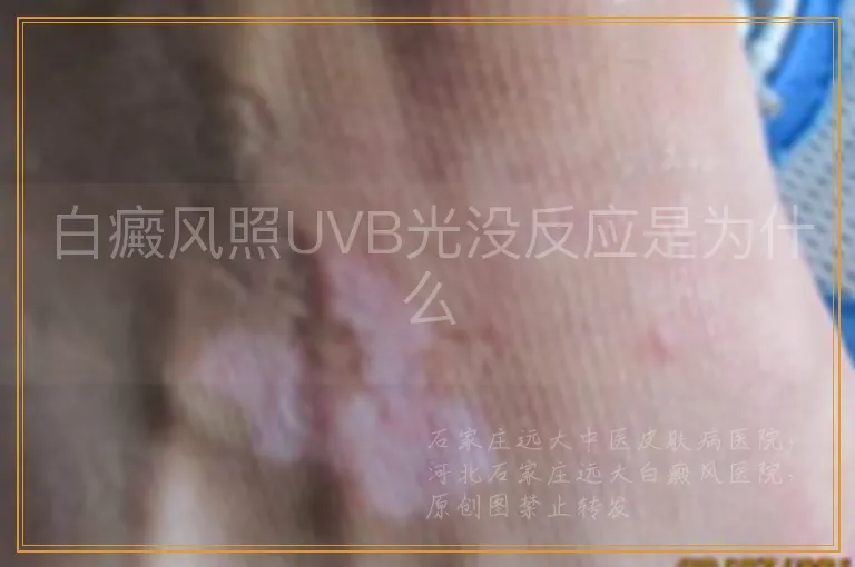 白癜风照UVB光没反应是为什么
