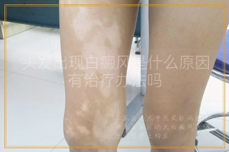 头发出现白癜风是什么原因有治疗办法吗