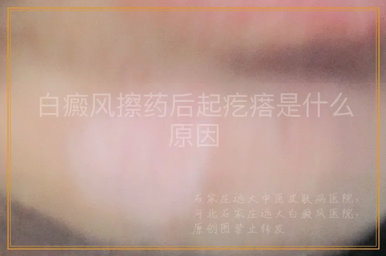 白癜风擦药后起疙瘩是什么原因
