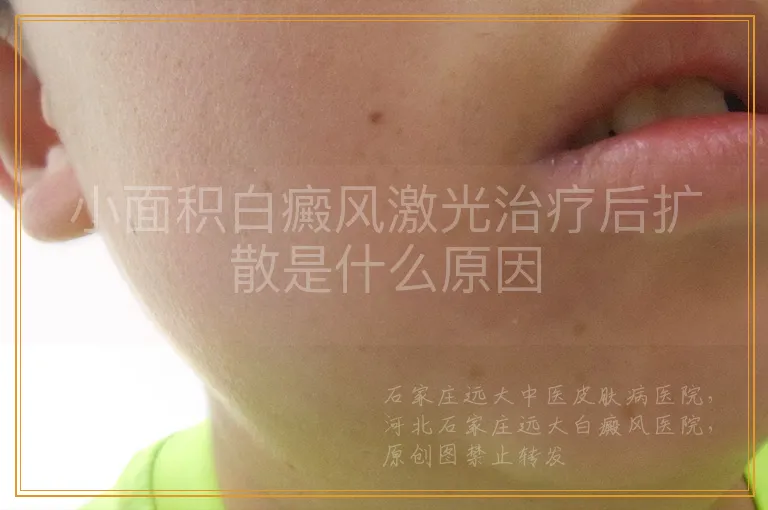 小面积白癜风激光治疗后扩散是什么原因