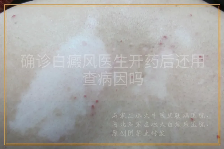 确诊白癜风医生开药后还用查病因吗