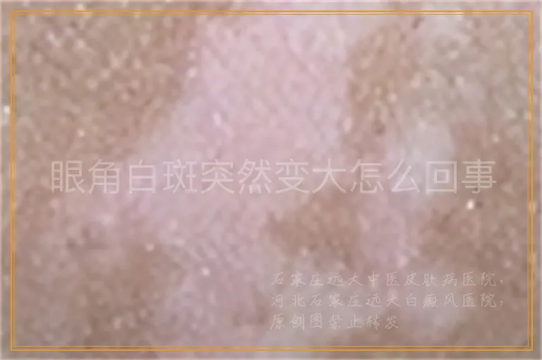 眼角白斑突然变大怎么回事
