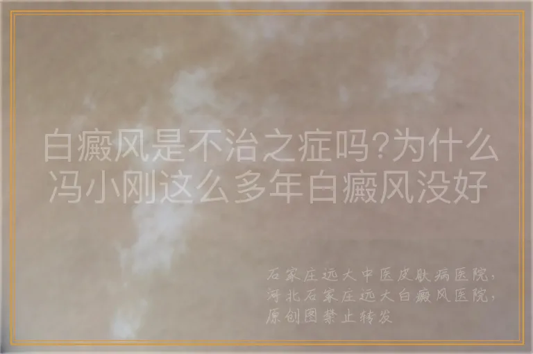 白癜风是不治之症吗?为什么冯小刚这么多年白癜风没好?