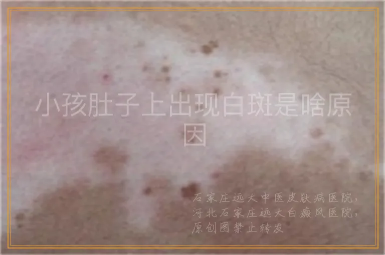 小孩肚子上出现白斑是啥原因