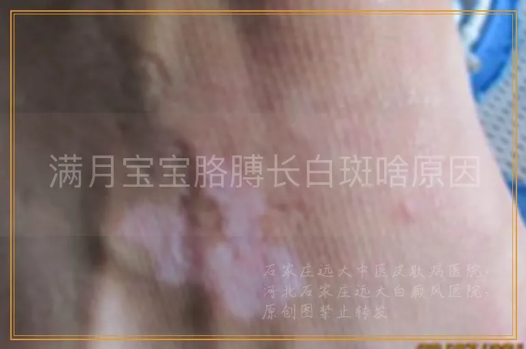 满月宝宝胳膊长白斑啥原因