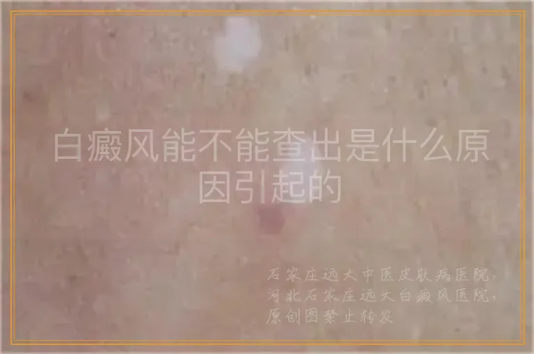 白癜风能不能查出是什么原因引起的
