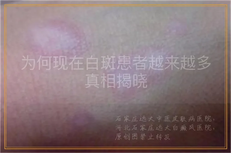 为何现在白斑患者越来越多真相揭晓