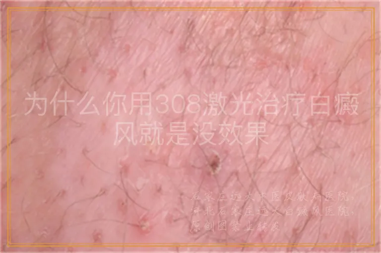 为什么你用308激光治疗白癜风就是没效果