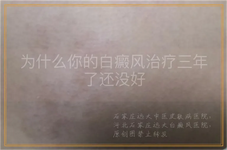 为什么你的白癜风治疗三年了还没好