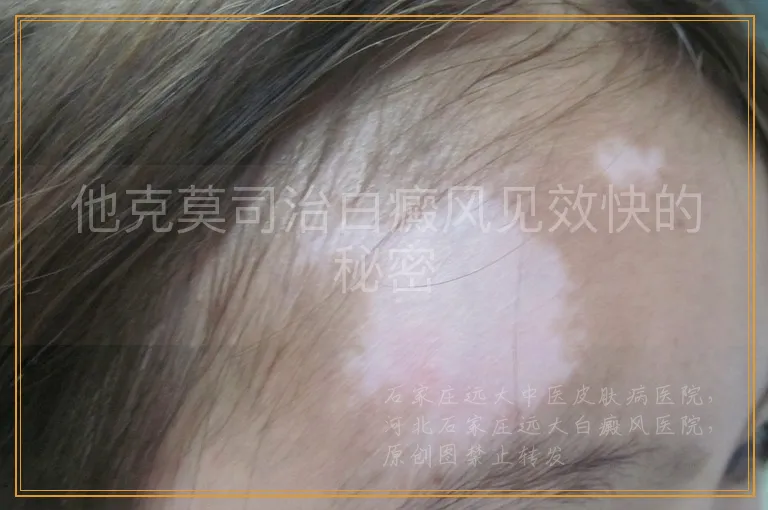 他克莫司治白癜风见效快的秘密