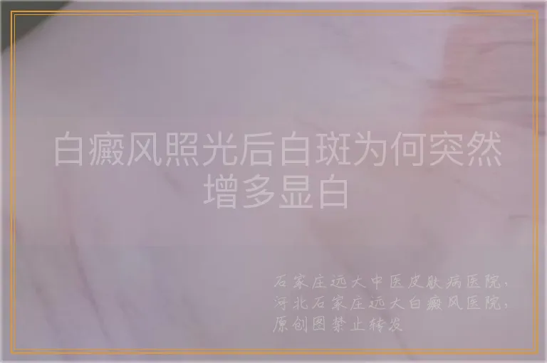 白癜风照光后白斑为何突然增多显白