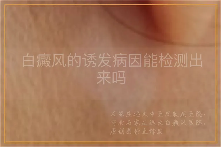 白癜风的诱发病因能检测出来吗