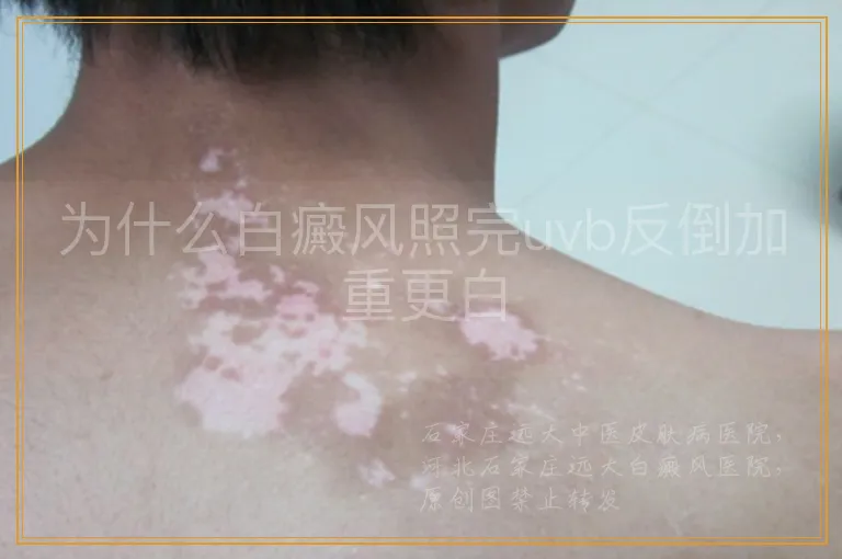 为什么白癜风照完uvb反倒加重更白