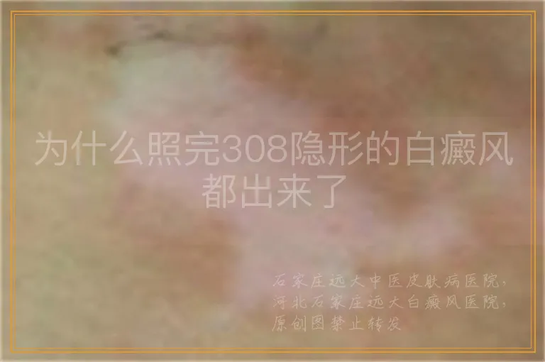 为什么照完308隐形的白癜风都出来了