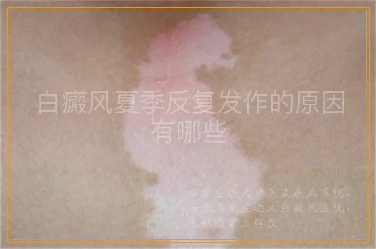 白癜风夏季反复发作的原因有哪些