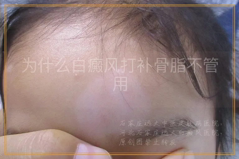 为什么白癜风打补骨脂不管用