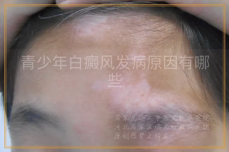 青少年白癜风发病原因有哪些