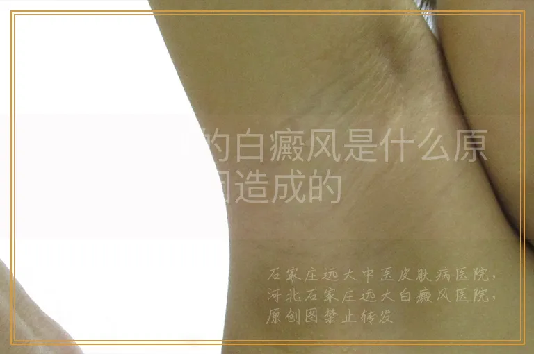 后天出现的白癜风是什么原因造成的