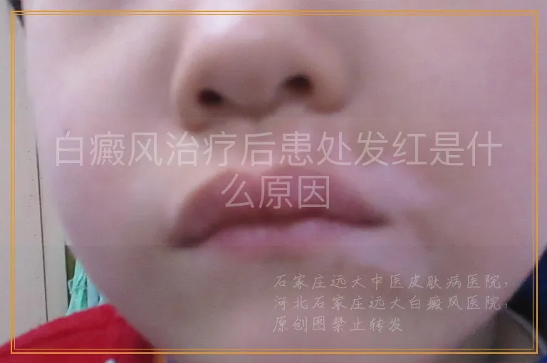 白癜风治疗后患处发红是什么原因