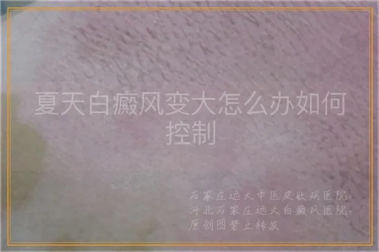 夏天白癜风变大怎么办如何控制