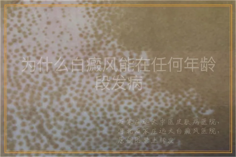 为什么白癜风能在任何年龄段发病