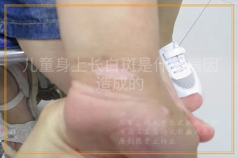 儿童身上长白斑是什么病因造成的