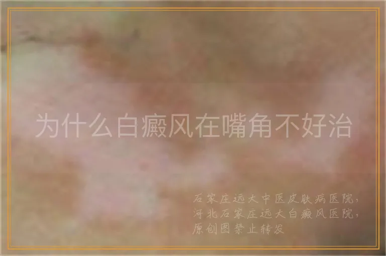 为什么白癜风在嘴角不好治