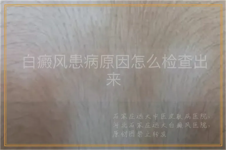 白癜风患病原因怎么检查出来